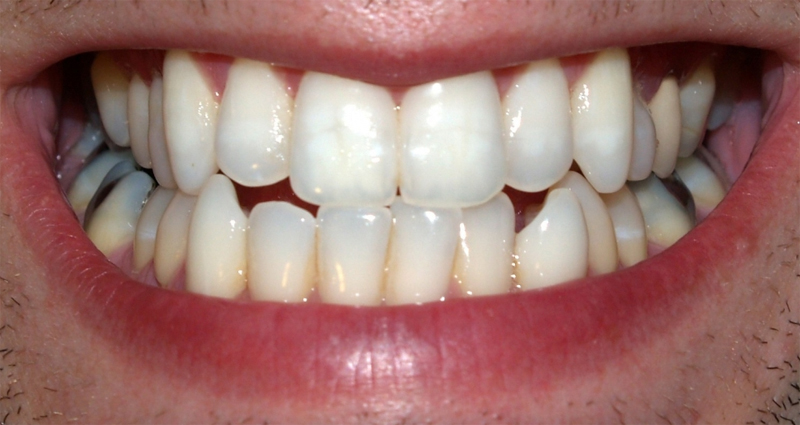 Software analisa perda óssea provocada por problemas no contato entre dentes