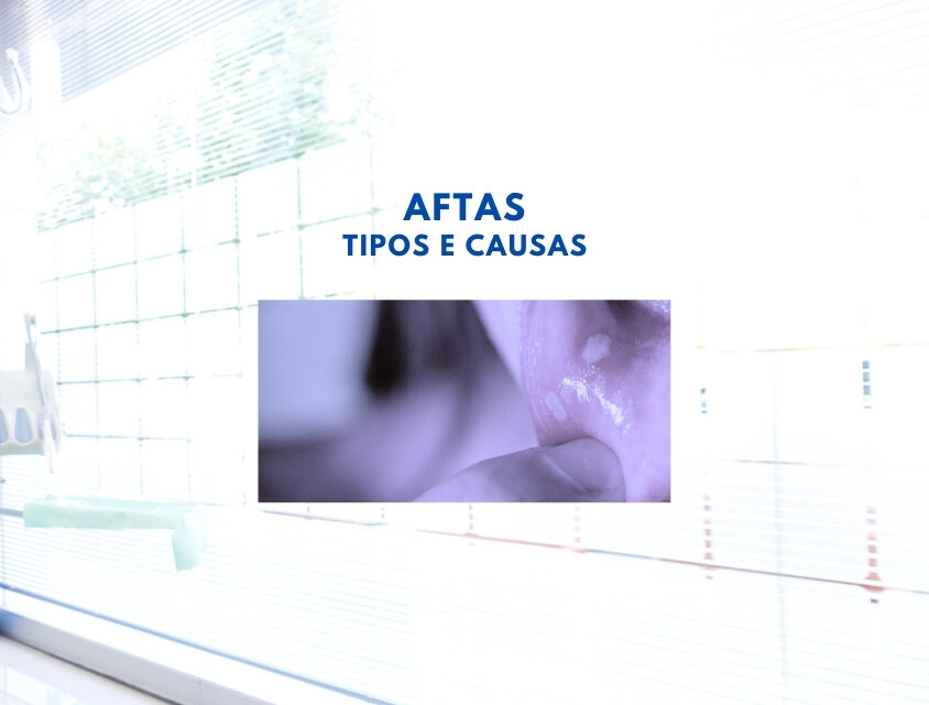 Aftas: entenda os principais tipos e causas