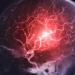 Estudo aponta redução de 39% de recorrência de AVC com uso de polipílula