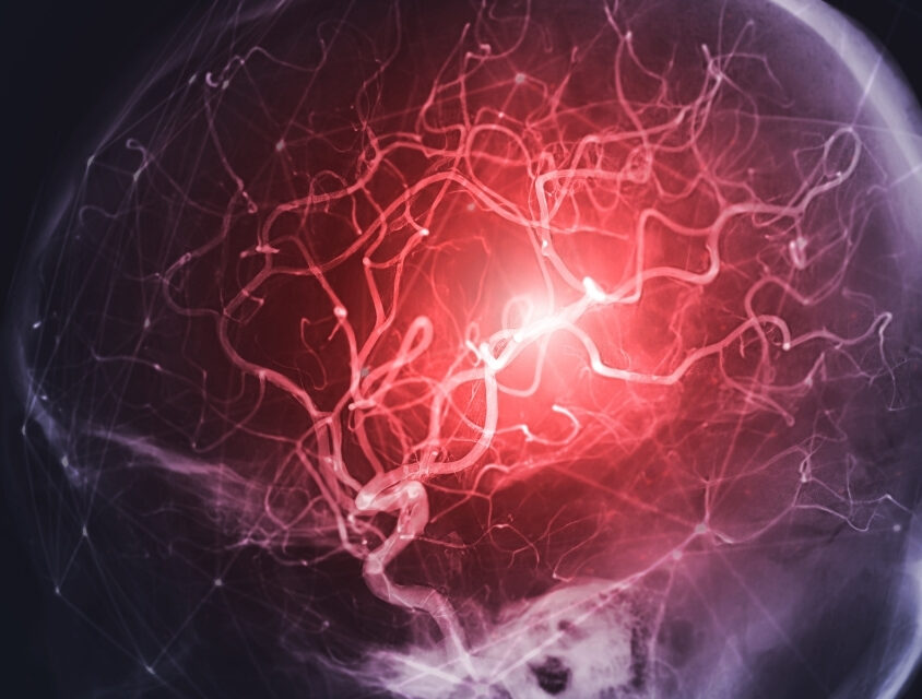 Estudo aponta redução de 39% de recorrência de AVC com uso de polipílula