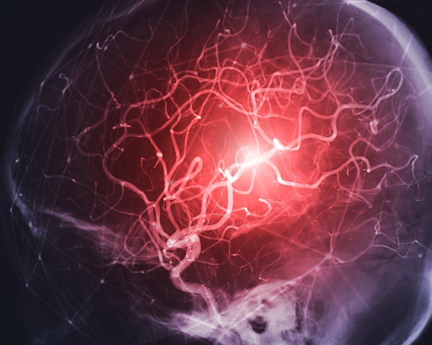 Estudo aponta redução de 39% de recorrência de AVC com uso de polipílula