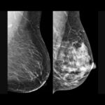 Mulher: Pesquisa brasileira desvenda como alguns tipos de câncer de mama ‘driblam’ tratamento