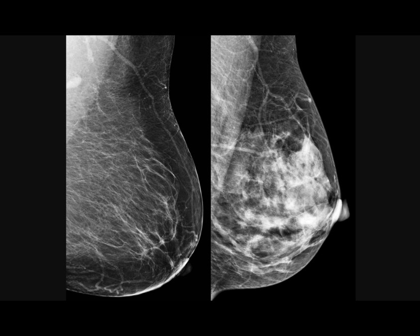 Mulher: Pesquisa brasileira desvenda como alguns tipos de câncer de mama ‘driblam’ tratamento