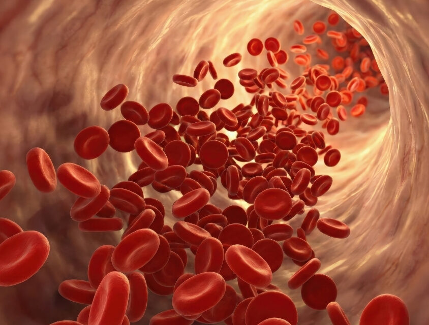 Aneurisma da aorta: entenda o que é a doença silenciosa que pode ser fatal